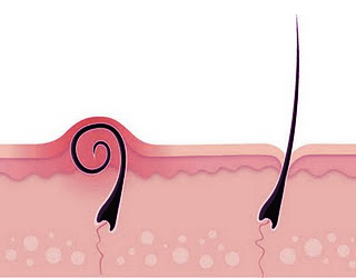 ingrown