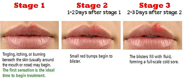 Cold Sore Picture Image on MedicineNet.com