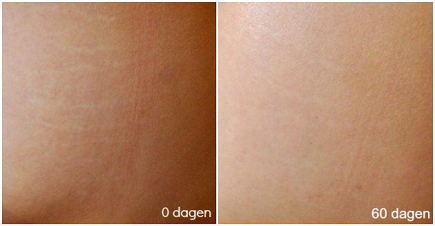 Specificiteit hoesten Moderniseren Bio-oil 90 dagen challenge - update #2 ⋆ Beautylab.nl