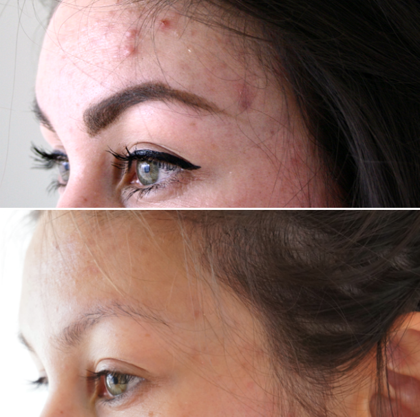 fase ACNE BEHANDELING ⋆ Beautylab.nl