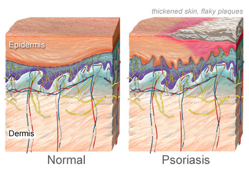 getty_rm_photo_of_illustration_of_psoriasis