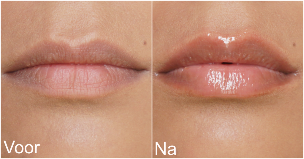 Wunderkiss | volle lippen binnen 2 minuten