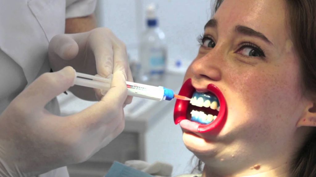 Verrassend genoeg Ongeëvenaard Malaise Dit gebeurt er tijdens het bleken van je tanden ⋆ Beautylab.nl