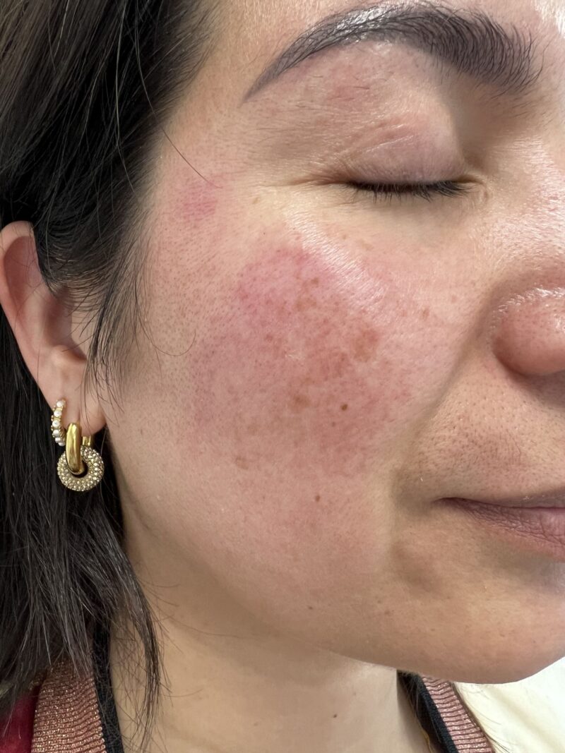 Wat is rosacea en wat kan ik ertegen doen?